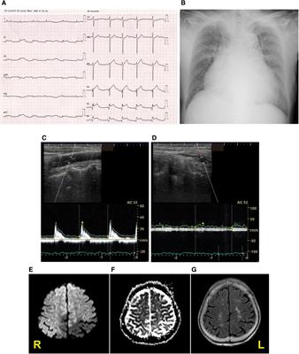 Case Report: Postmortem brain and heart pathology unveiling the pathogenesis of coexisting acute ischemic stroke and electrocardiographic abnormality